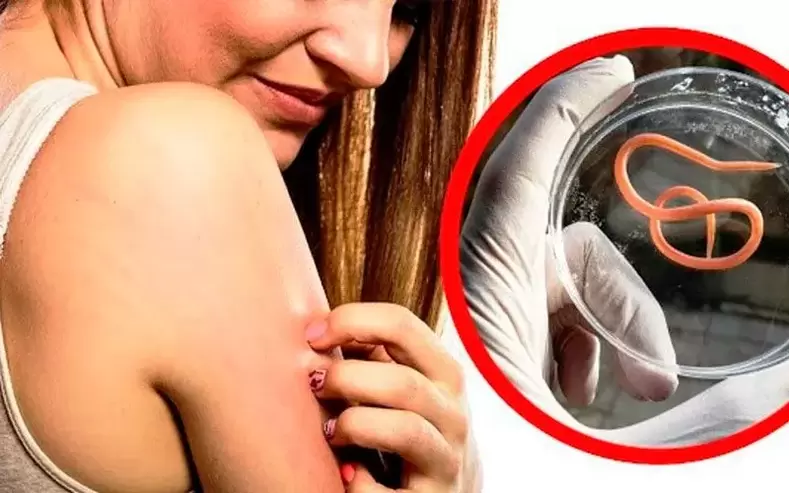 gatal-gatal sareng iritasi kusabab parasit dina awak